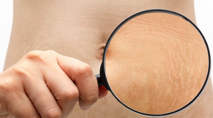 How to make your stretch marks less visible?