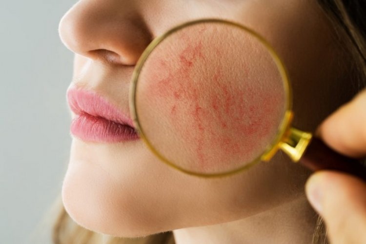 Stress can ruin your skin and this is what you can do