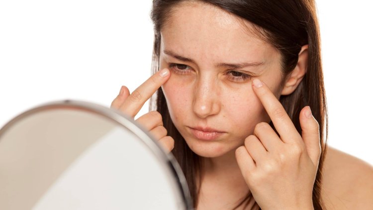 How to get rid of dark circles under eyes