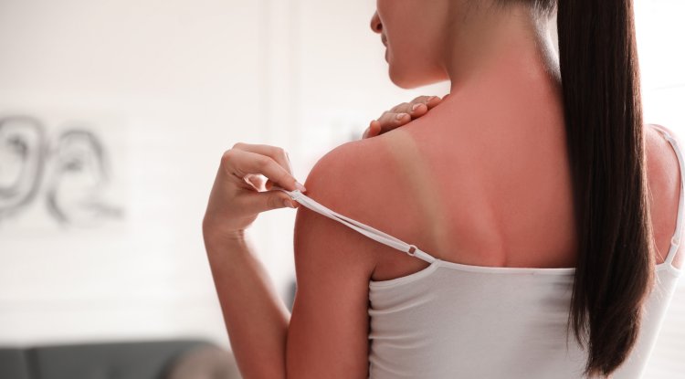 How to treat sunburn?