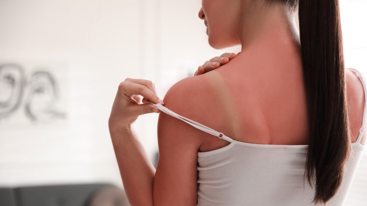 How to treat sunburn?